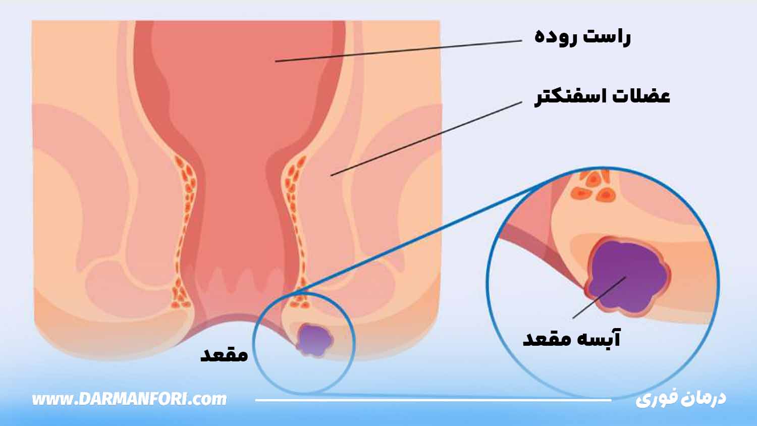 آبسه مقعدی با دارو درمان میشود؟ تصویر آبسه مقعدی در ناحیه مقعد